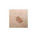 Dermatoskop LuxaScope LED Pure White bateryjny widok.jpg