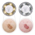 Dermatoskop Luxamed LuxaScope CCT LED – dwie barwy światła, gładka płytka kontaktowa 2.jpg