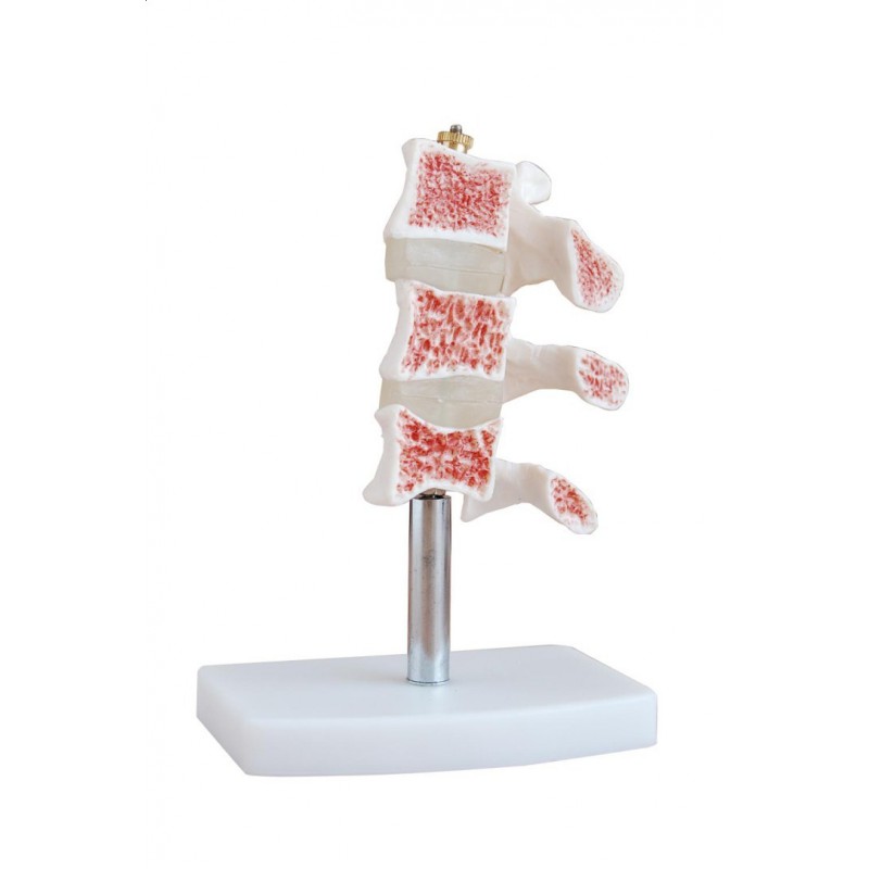 Model z fragmentami osteoporozy